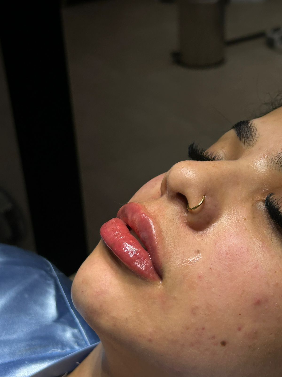 Depois — resultado de preenchimento labial com ácido hialurônico